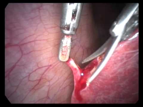 Laparoscopic Cholecystectomy (unedited-66)-GB Polyp-Managing Perforation During Surgery Liver Biopsy