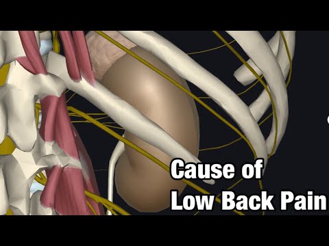 Video: Bolehkah plexus menyebabkan sakit kepala?