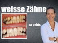 WEISSE ZÄHNE :Bleaching beim ZAHNARZT: das musst du WISSEN, LIVEbehandlung