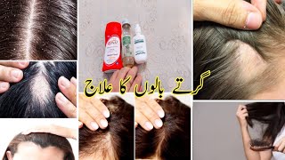 Girty balon ka ilaj || No Dandruff & Hair loss