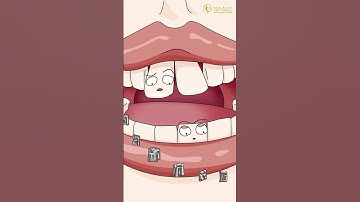 Niềng răng điều trị khớp cắn hở vô cùng quan trọng #nhakhoavietsmile #niengrang