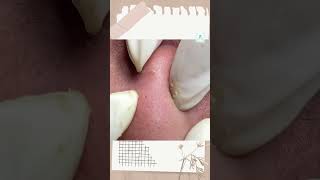 Big Cystic Acne Blackheads Extraction Blackheads & Milia, Whiteheads Removal Pimple Popping shorts