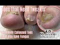 👣Pedicure Transformation on Dry Calloused Feet and Toenail Fungus👣