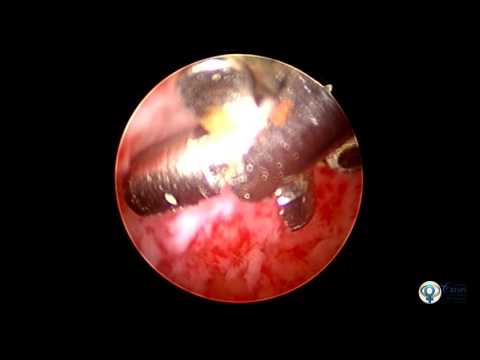 Vídeo: Remoção Histeroscópica De Pólipos Endometriais