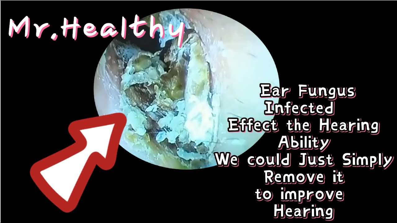 [Ear Wax Extraction] Remove Ear Fungus Infected effect the Hearing