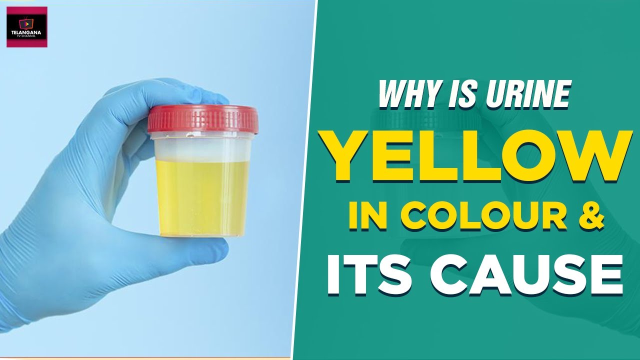 Dark Yellow Urine Causes If Your Urine Is This Color It Could Be Dark Yellow Urine Causes If Your Urine Is This Color It Could Be