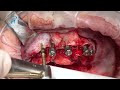 Dental Implants Placement - Extreme Case