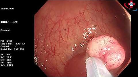 Cận cảnh cắt polyp đại tràng tại Phòng khám đa khoa Hưng Hà Phố Nối