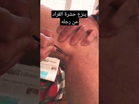 شاهد كيف ينزع حشرة القراد من رجله