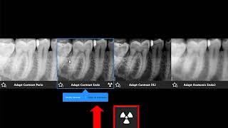 Dental Imaging Software  Using the CS Adapt Filter Library Recorded Class Profile