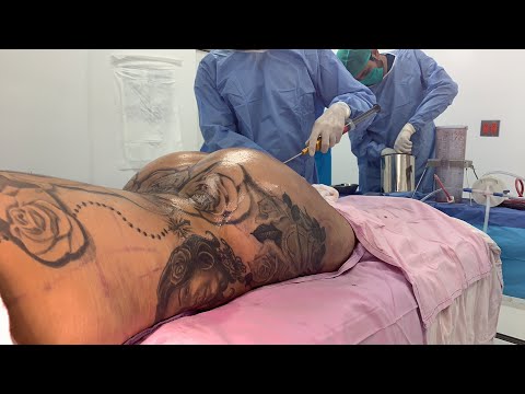  Big Butt Lift BBL and Butt Implants in Tijuana Mexico