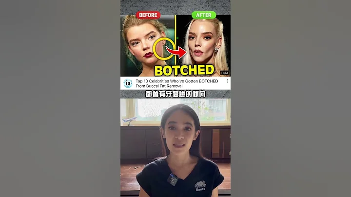 什么人容易有牙套脸，最后一个原因矫正医师可尽量控制#牙齿矫正 - 天天要闻
