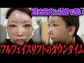 【顔面一周剥ぐ整形】過去一苦しいダウンタイムの真実を術後すぐにお話します