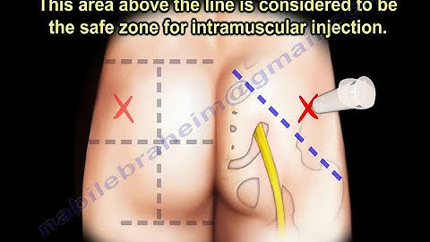 Glute Injection ,Buttock injection - Everything You Need To Know - Dr. Nabil Ebraheim