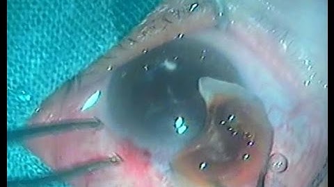 Intra Tunnel Phaco Fracture (ITPF)  SICS In Rock Hard Nuclear Cataract #149