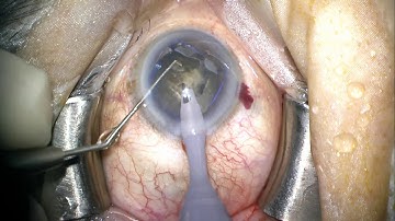 miLoop with Malyugin ring for hard brown cataract- Dr Sheetal Brar