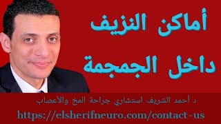 د أحمد الشريف #73 | أنواع النزيف داخل الجمجمة