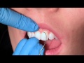Exploring anterior teeth