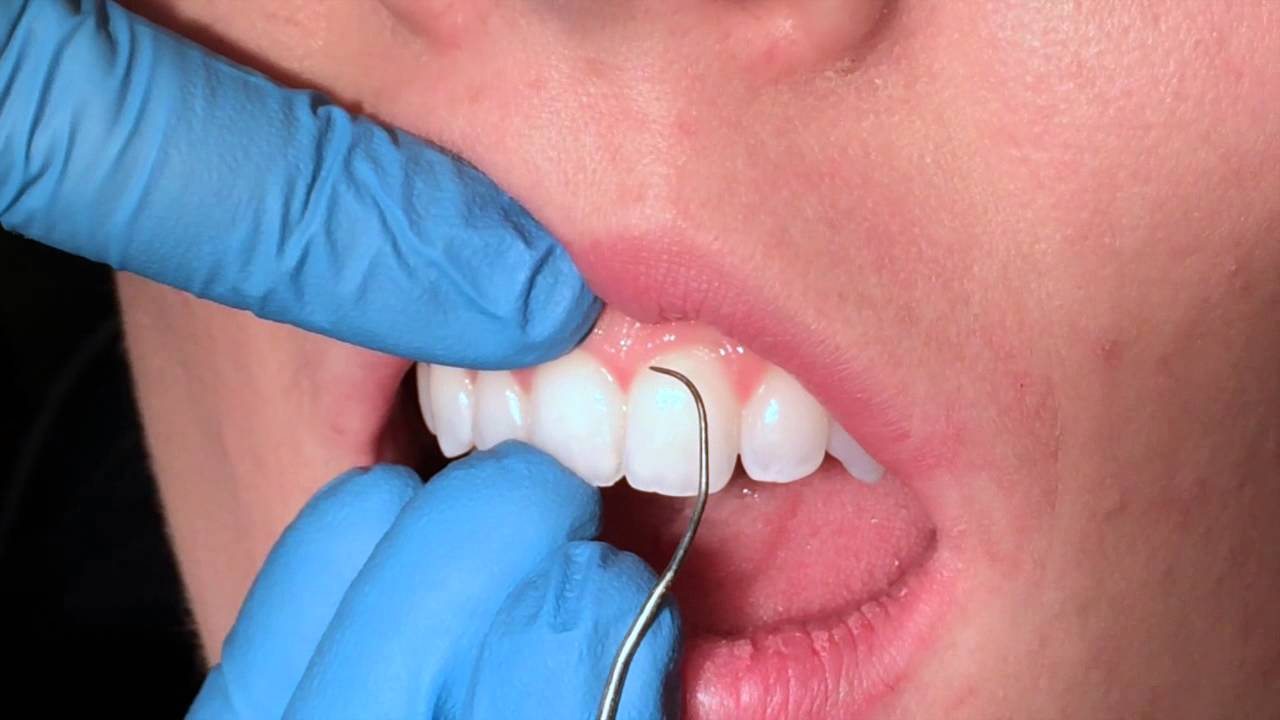 Exploring Anterior Teeth Youtube