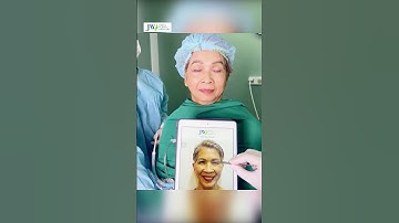 Treo chân mày nội soi 4X chỉ 60 phút xóa NẾP NHĂN trán, cau mày, chân chim triệt để