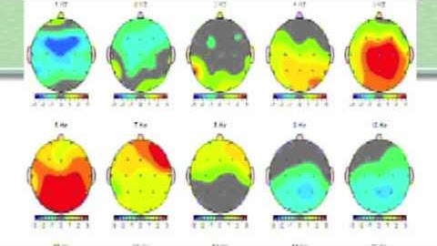 Becky Bingham: Brain maps, Part 2 The QEEG report