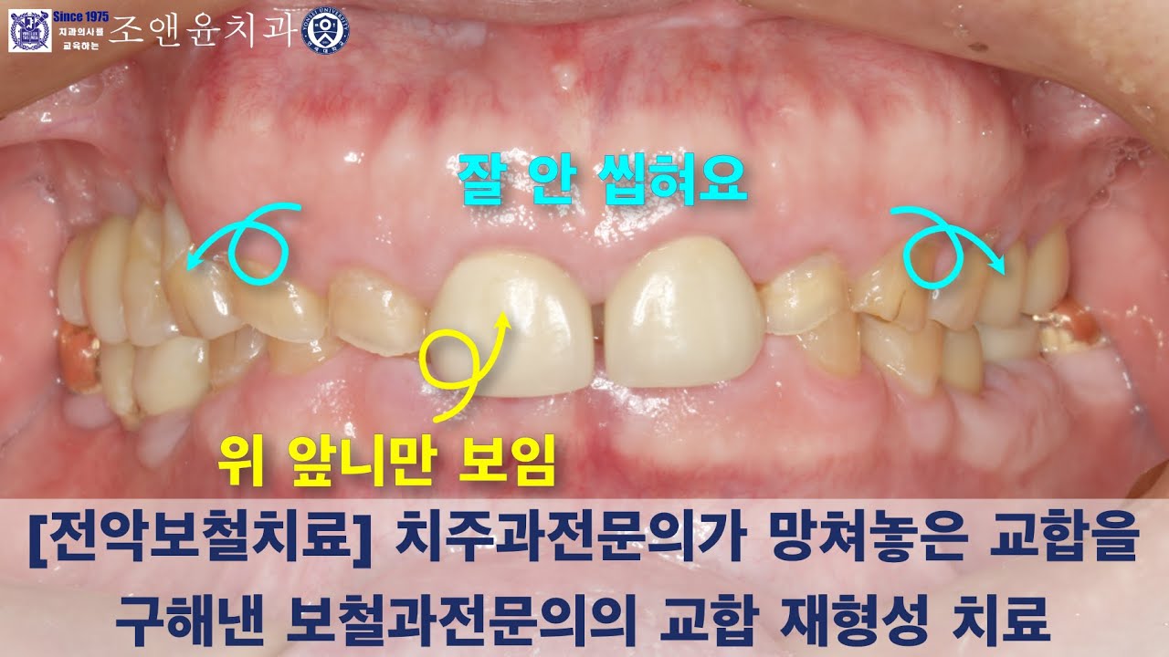 [내일남] 치과치료의 꽃이라고 불리는 보철치료, 보철과전문의가 보여주는 화려한 전악보철치료 : 치주과전문의가 망쳐놓은 교합을 구해낸 보철과전문의의 교합 재형성 과정