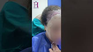 د.محمد محمود II زراعة الشعر للسيدات II تصغير الجبهة للنساء