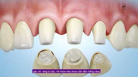 PHÂN VÂN NÊN NIỀNG RĂNG HAY BỌC RĂNG SỨ? XEM NGAY VIDEO NÀY!