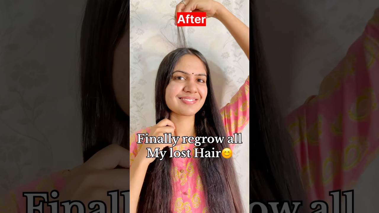 How to reduced Hairfall & regrow lost Hair | my Hairloss🥺 to HairGrowth journey #shorts #hairfall