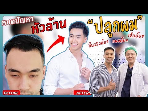 ปลูกผม แล้วผมจะขึ้นจริงมั้ย เจ็บมั้ย แพงมั้ย คลิปนี้มีคำตอบครบทุกอย่าง | Fit Design X Max Hair