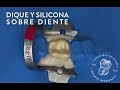 Aislamiento Absoluto: Técnica Dique sobre diente y Silicona sobre diente.
