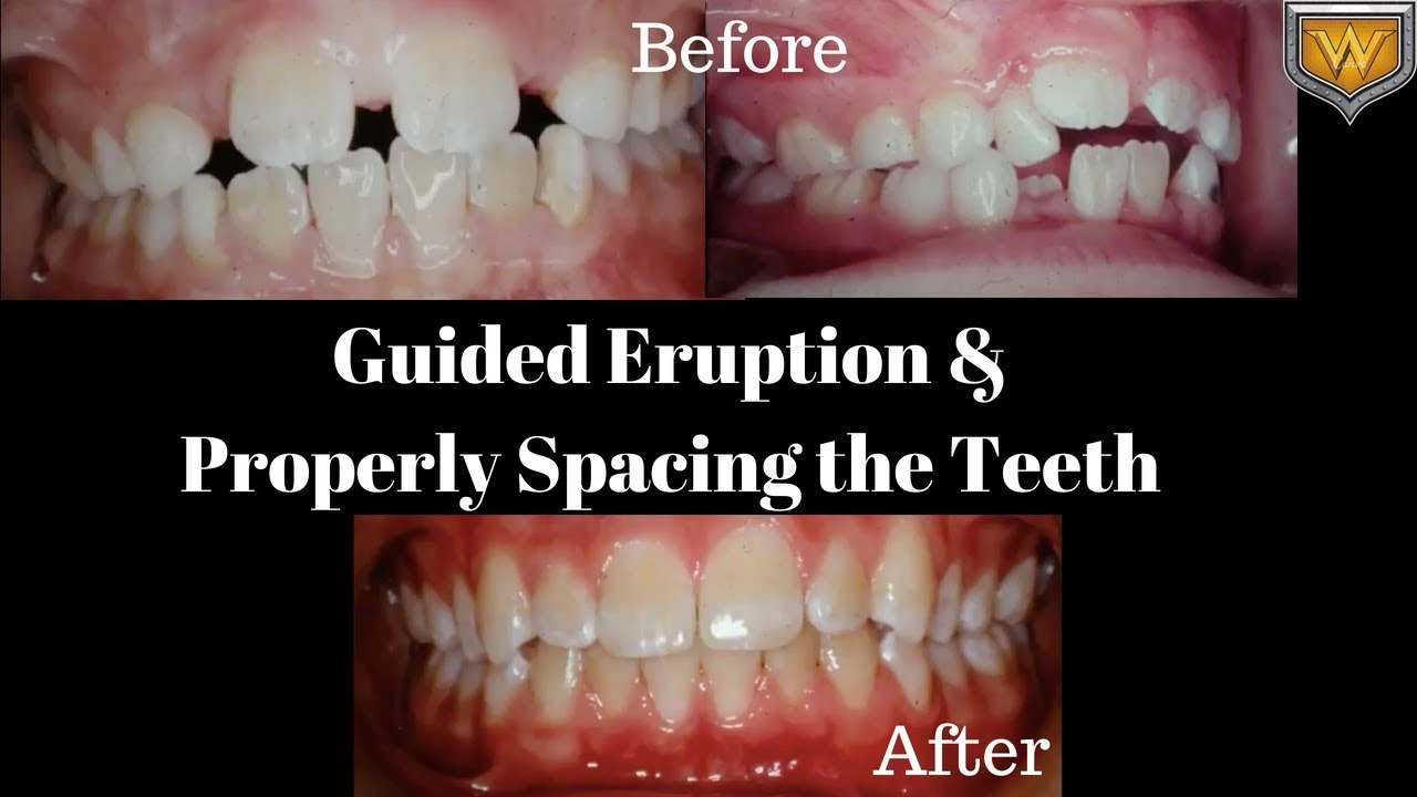 Guided eruption & properly spacing the teeth YouTube