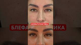 Круговая блефаропластика.