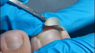 Hoof trim！A piece of Curved toenail was removed. Ingrown nails removal.