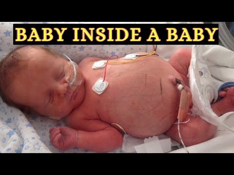 Baby born with her Twin inside her Stomach|| FETUS IN FETU