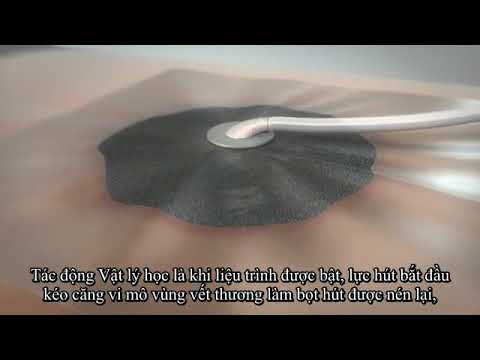 Video Liệu Pháp Điều Trị Vết Thương Bằng Máy Hút Áp Lực Âm-... - youtube