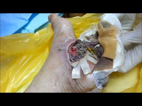 Maggot Therapy for Diabetic Wound by Dr HC Chang