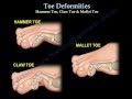 Toe Deformities Hammer, Claw & Mallet Toes - Everything You Need To Know - Dr. Nabil Ebraheim