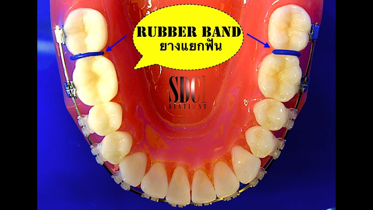 จัดฟันด้วยยางแยกฟัน (Orthodontic Separators) YouTube
