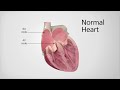 Normal Heartbeat vs Atrial Fibrillation (Afib)