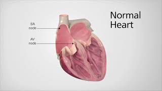 Normal Heartbeat vs Atrial Fibrillation (Afib)