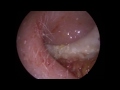 Blood filled EAR PIMPLE POPPED to assist removing Keratosis Obuturan from Ear Canal - #338