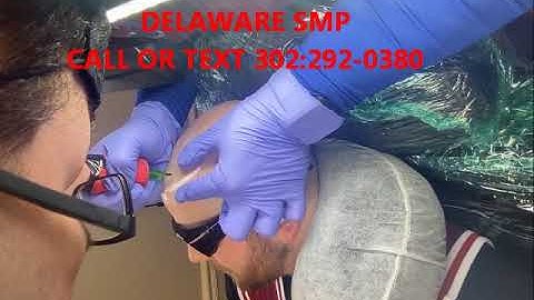 Scalp Micropigmentation in Delaware