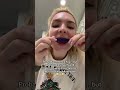 🤔🤫 #teethwhitening #girlssupportgirls #fyp #teethtransformation #glowupforreal #teeth #couplegoals
