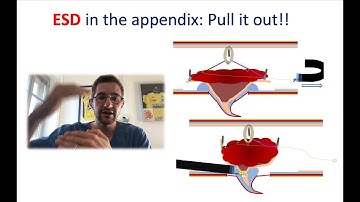 Focus - endoscopic submucosal dissection (ESD) in the appendix: Pull it out!!