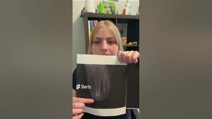 Why I Can't Wear My Prosthetic Leg (Part Two)