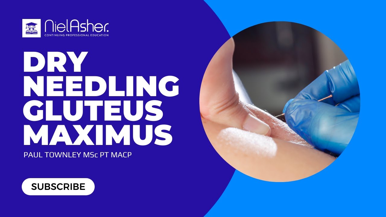 Dry Needling Gluteus Maximus YouTube