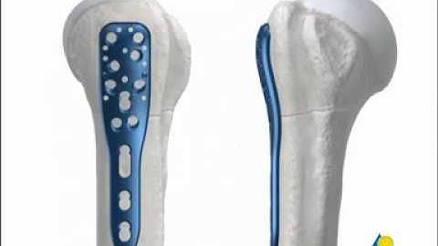 Proximal Humerus Internal Locking System PHILOS