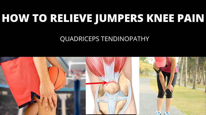 How to Relieve Jumpers Knee Pain | Quadriceps Tendinopathy