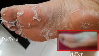 Feetyhealy - Ugly Feet To Feet Model In 1 Easy Step